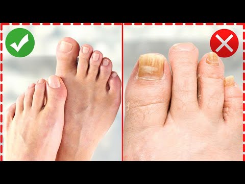Видео: ПЕДИКЮР И САХАРНЫЙ ДИАБЕТ! Что Должен Знать Каждый Из Вас! (Обязательно к Просмотру!)