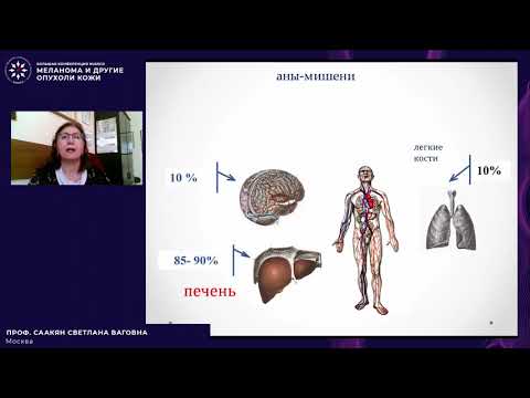 Видео: Увеальная меланома: особенности лечения и динамического наблюдения при локализованных стадиях