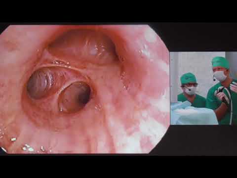 Видео: 04Live Сивокозов ИВ Бронхоскопия EBUS TBNA ЭБУС ТИП cT2NxM1pulm