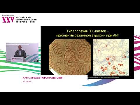 Видео: Полипы желудка: разбор клинических случаев. Нейроэндокринная опухоль желудка