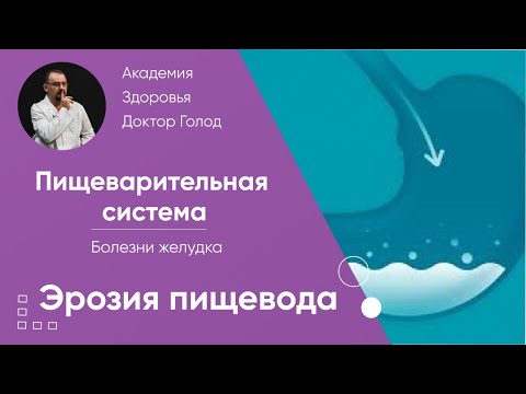 Видео: Эрозия пищевода.