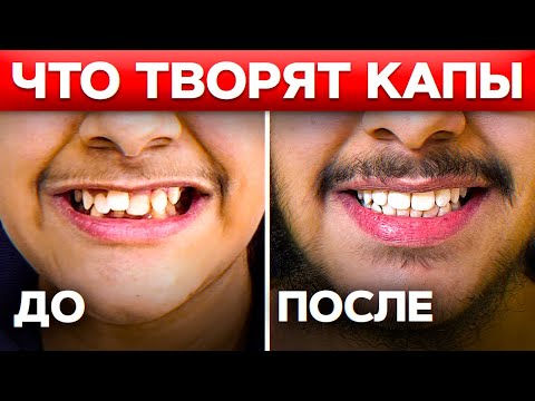 Видео: Как БЫСТРО выровнять зубы БЕЗ БРЕКЕТОВ? РЕЗУЛЬТАТ 100% / Современная ортодонтия