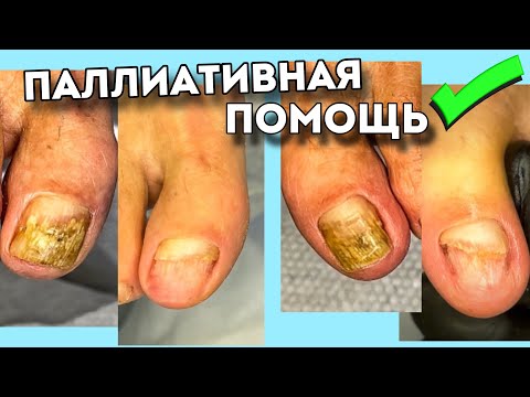Видео: Почему лечение не назначено | гигиена ногтей пожизненно