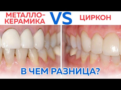 Видео: Какие коронки делать? / Плюсы и минусы металлокерамики и диоксида циркония