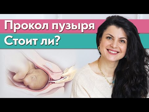 Видео: Как прокалывают околоплодный пузырь? | Что такое амниотомия?