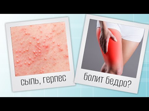 Видео: Герпес и защемление седалищного нерва | изПРАКТИКИ