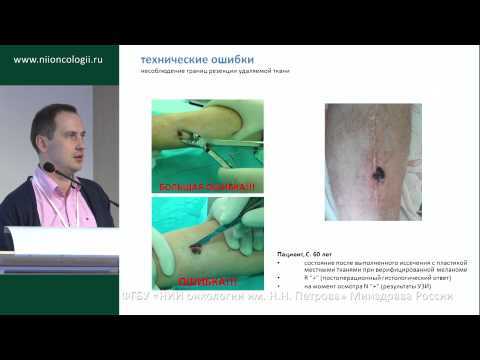 Видео: Ошибки хирургического лечения меланомы кожи (В.В. Егоренков)