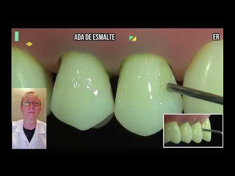 Видео: TOP 2 ERRORS / ТОП 2 ОШИБКИ в лечении клиновидного дефекта зубов