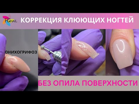 Видео: Коррекция клюющих ногтей без опила поверхности/ Онихогрифоз