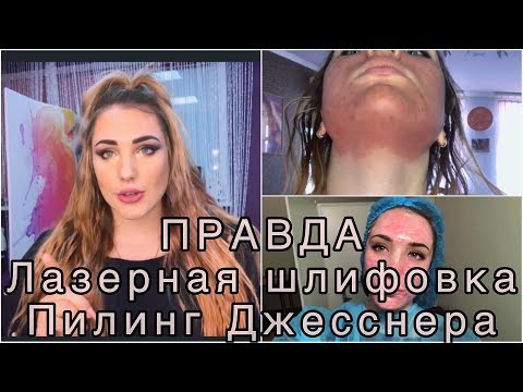 Видео: ОТЛИЧИЕ ЛАЗЕРНОЙ ШЛИФОВКИ ОТ ПИЛИНГА ДЖЕССНЕРА