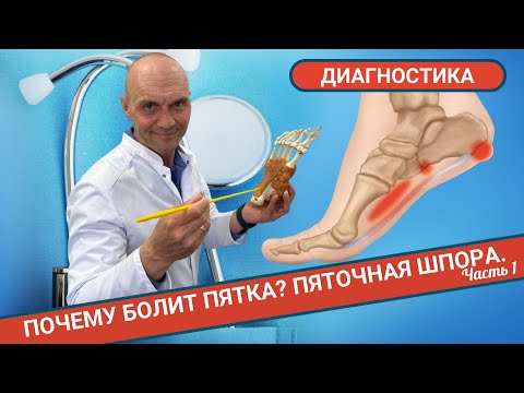 Видео: ПОЧЕМУ БОЛИТ ПЯТКА? ПЯТОЧНАЯ ШПОРА. Диагностика. (Часть 1)