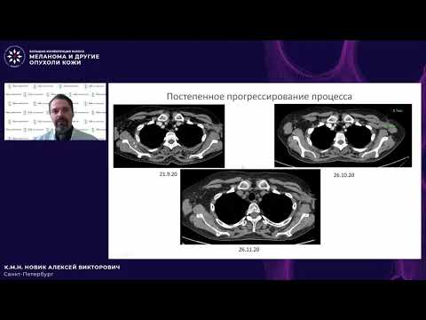 Видео: Меланома и другие опухоли кожи: в поисках оптимальных решений (панельная дискуссия) Кл. случай 2