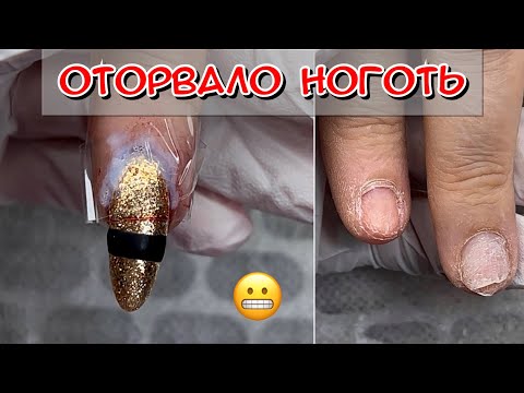 Видео: Сорвало ноготь / Сломала ноготь что делать / Сорвала ноготь / травма ногтя / Травмировала ноготь