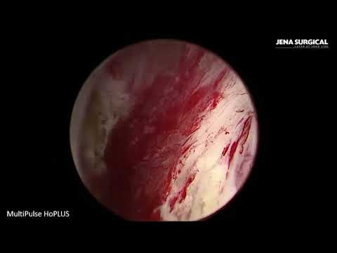 Видео: Лазерная энуклеация аденомы простаты (HoLEP). Гольмиевый лазер MultiPulse HoPlus 140W.