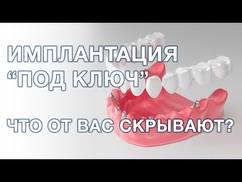 Видео: Имплантация зубов под ключ. Что это значит?