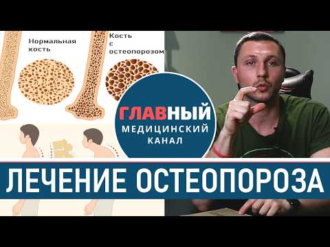 Видео: Как лечить ОСТЕОПОРОЗ костей. Лечение остеопороза у женщин и мужчин, профилактика