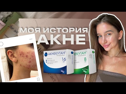 Видео: КАК Я ПОБЕДИЛА АКНЕ | Моя история борьбы и лечения | РЕТИНОИДЫ