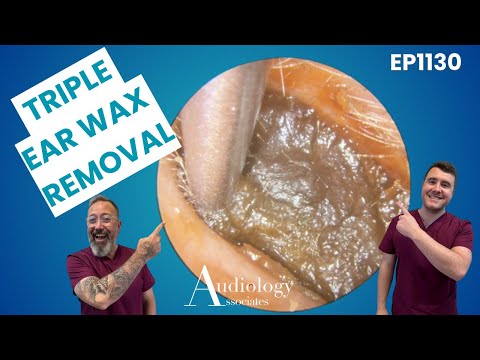 Видео: Что происходит, когда скопление ушной серы становится действительно сильным? - EP1030