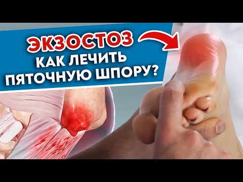 Видео: Проверьте ноги на ЭКЗОСТОЗ! Как понять, что у вас ПЯТОЧНАЯ ШПОРА? Лечебный массаж стоп