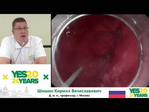 Видео: 45. Радиочастотная абляция длинного сегмента пищевода Баррета. К. В. Шишин