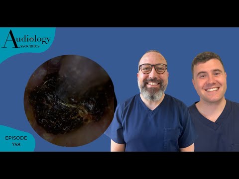 Видео: Удаление ушной серы/удаление влажной кожи с помощью CHOCKABLOCK - EP758