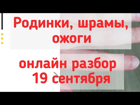 Видео: Родинки, шрамы, ожоги на руках.