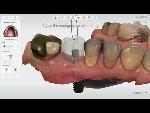 Видео: 3Shape Implant Studio 2019 – Создание коронки с винтовой фиксацией - Screw-Retained Crown Workfllow