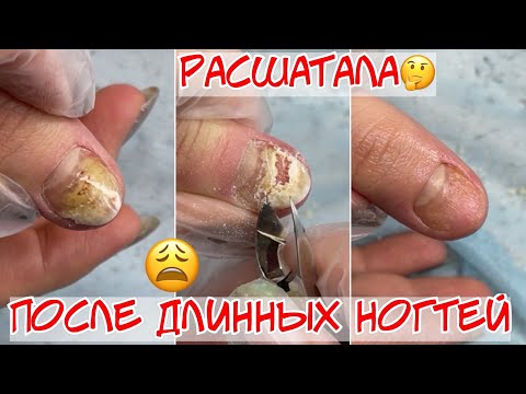Видео: Расшатала ноготь до онихолизиса😫😱 Чем опасны длинные ногти?