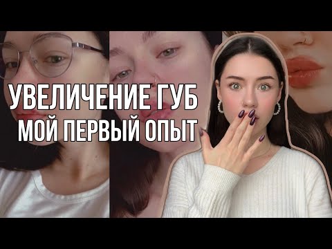 Видео: Мой Первый Опыт Увеличения Губ 🫦