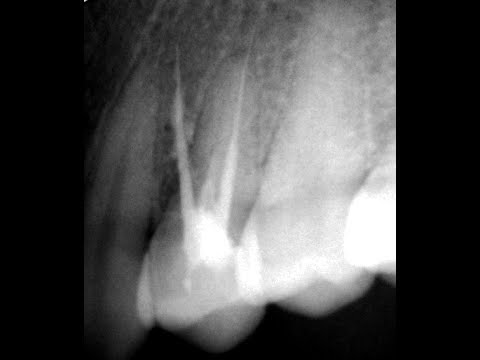 Видео: Как закрыть перфорацию зуба? Перфорация корня зуба. Что такое перфорация зуба
