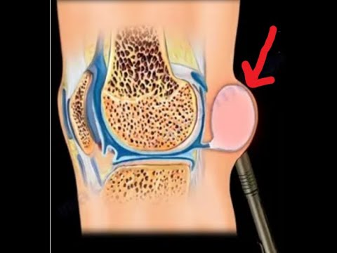 Видео: Киста Бейкера, ее связь с разрывами мениска и артритом коленного сустава