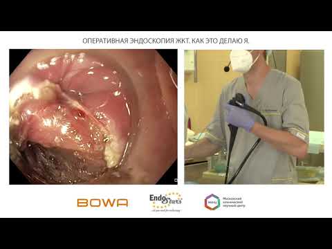Видео: Оперативная эндоскопия ЖКТ. Дивертикул Ценкера. О. Б. Ткаченко, И. Ю. Недолужко, К. В. Шишин
