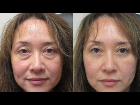 Видео: Как Убрать Отеки С Лица И Глаз | Доктор Вивек