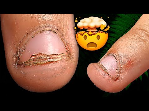 Видео: 🤢 Очень ОБГРЫЗЕННЫЕ НОГТИ!😰 Наращивание в 12 лет?! МАНИКЮР в школу.НАРАЩИВАНИЕ НОГТЕЙ.ПРЕОБРАЖЕНИЕ