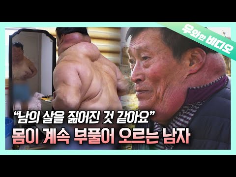 Видео: 29 лет жизни с опухшим телом