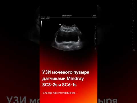 Видео: УЗИ мочевого пузыря датчиками Mindray SC8-2s, SC6-1s #shorts #tiktok #short #reels #узи #мастеркласс