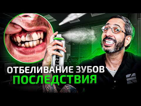 Видео: Отбеливание зубов в 2023 — возможные последствия. Безопасность и безболезненность отбеливания