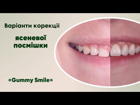 Видео: Варіанти корекції «ясеневої посмішки» | Ортодонт Б.Свінціцький