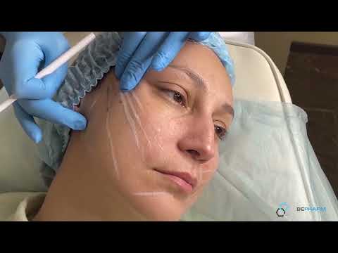 Видео: Лифтинг средней и нижней трети лица с применением нитей с насечками