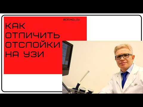 Видео: Как отличить отслойку стекловидного тела от отслойки сетчатки на УЗИ?