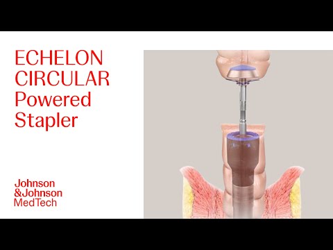 Видео: Как использовать электрический степлер ECHELON CIRCULAR | J&J MedTech