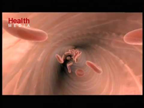 Видео: Как се запушват артериите