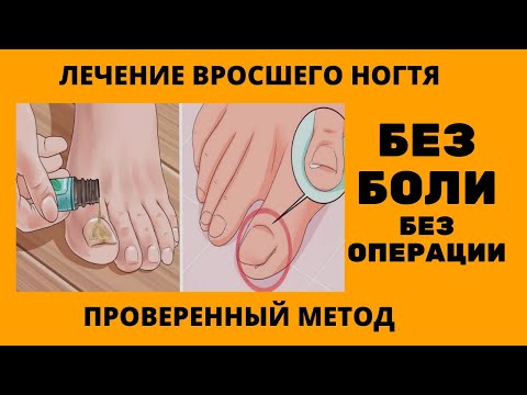 Видео: Как вылечить вросший ноготь самый простой способ