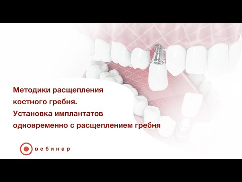Видео: Методики расщепления костного гребня. Установка имплантатов одновременно с расщеплением гребня