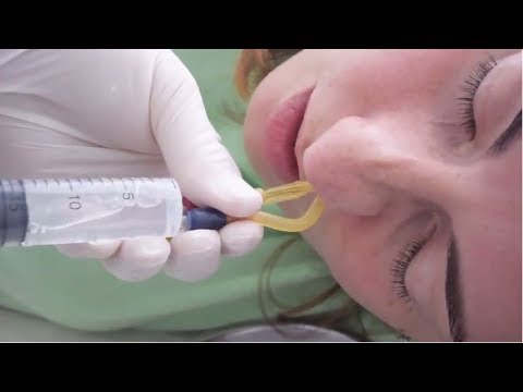 Видео: Лечение гайморита у взрослых. Как быстро вылечить гайморит без прокола.