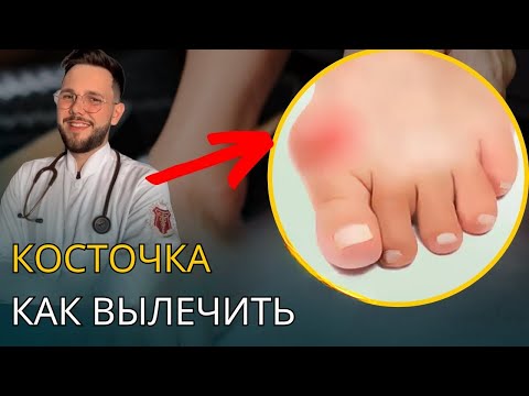 Видео: КАК ЛЕЧИТЬ КОСТОЧКУ СТОПНОГО МОСТА ДОМА С ПОМОЩЬЮ ВСЕГО 3 УПРАЖНЕНИЙ