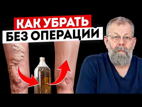 Видео: Варикоз ИЗЛЕЧИМ! Нужно только...