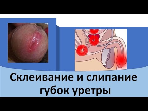 Видео: Склеивание и слипание губок уретры