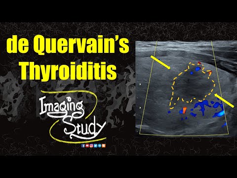 Видео: Тиреоидит де Кервена || Ультразвуковое исследование || Случай 360