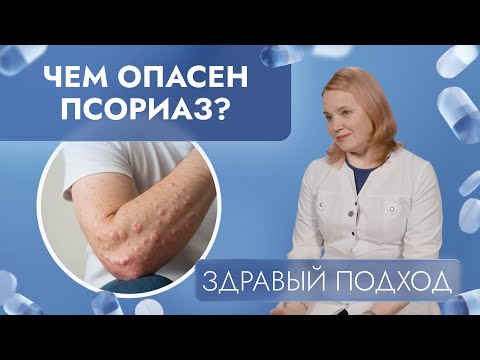 Видео: Чем опасен псориаз? | Здравый подход (2025)